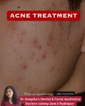 Acne Treatment