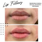 Lip fillers