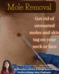 Mole removal